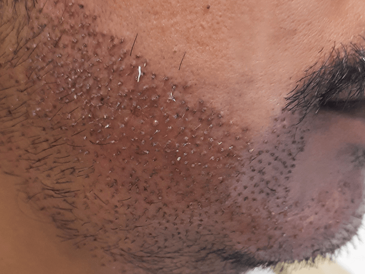 beard-implantation