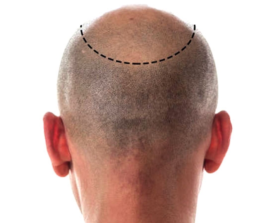 hair-trimming