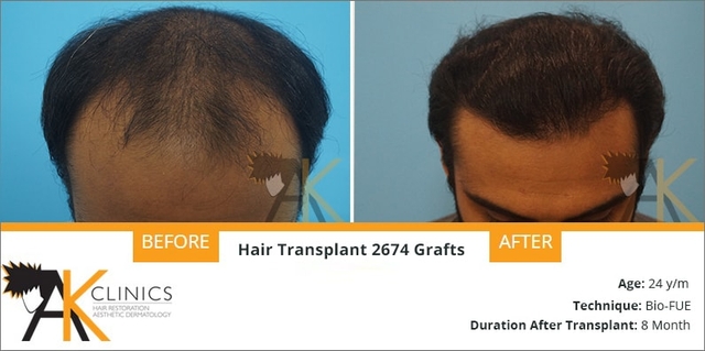 2674 Grafts BIO-FUE Result