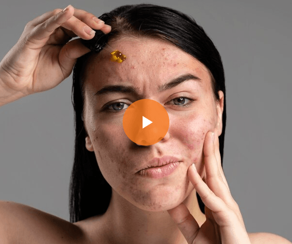acne-video-img
