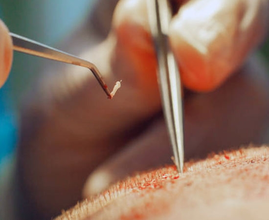 Follicular-Extraction