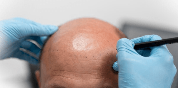 what-is-hair-transplant