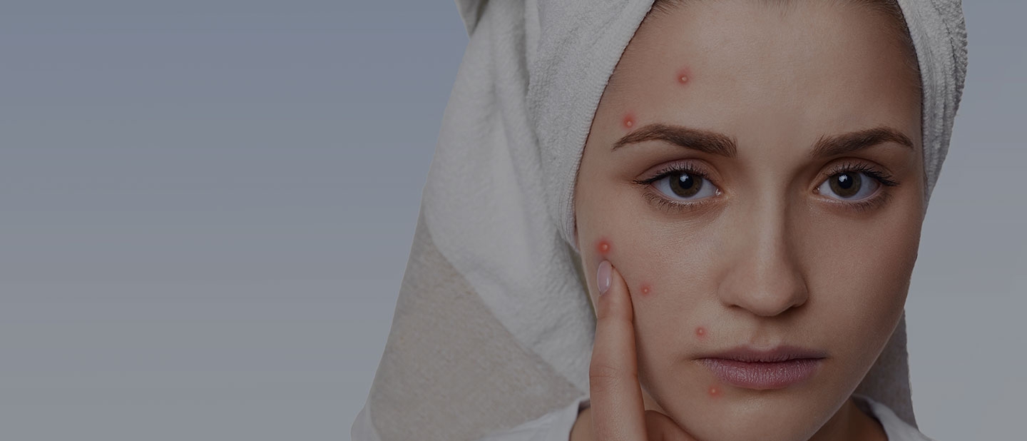 acne-treatment-banner