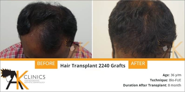 2240 Grafts With Bio Fue Result