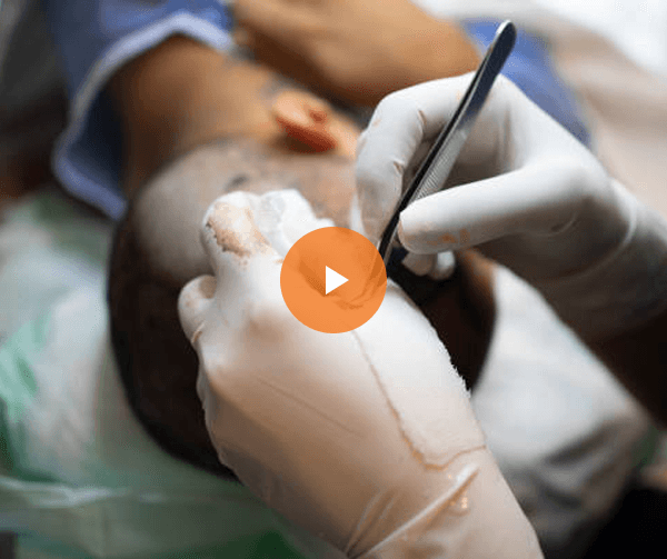 How is Men Hair Transplantis done?