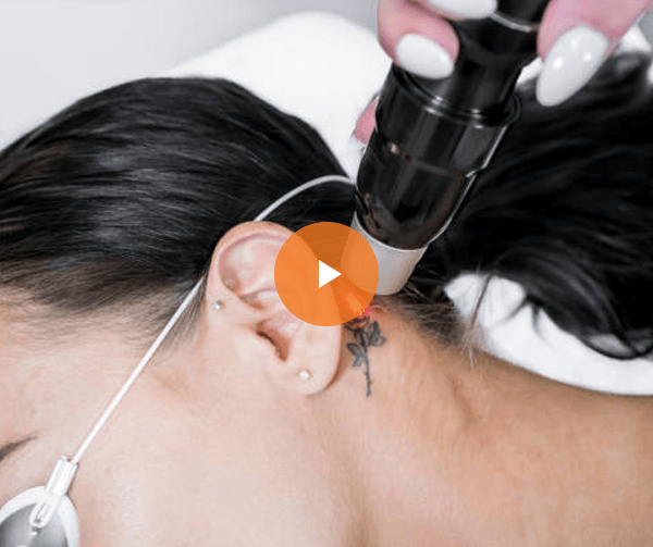 video-laser-tattoo-removal