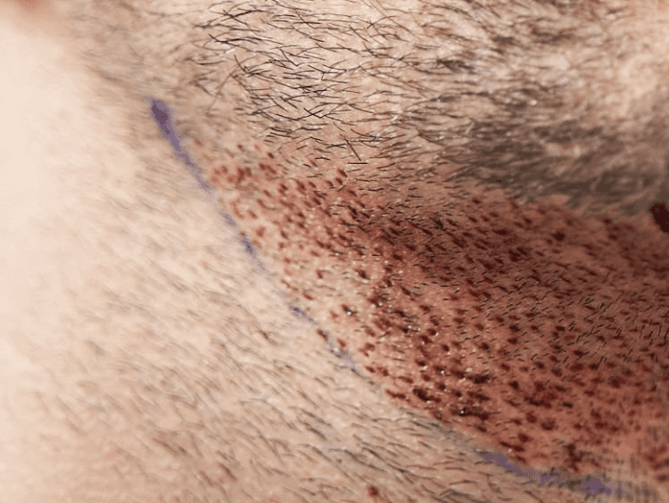 cost of beard transplant in india