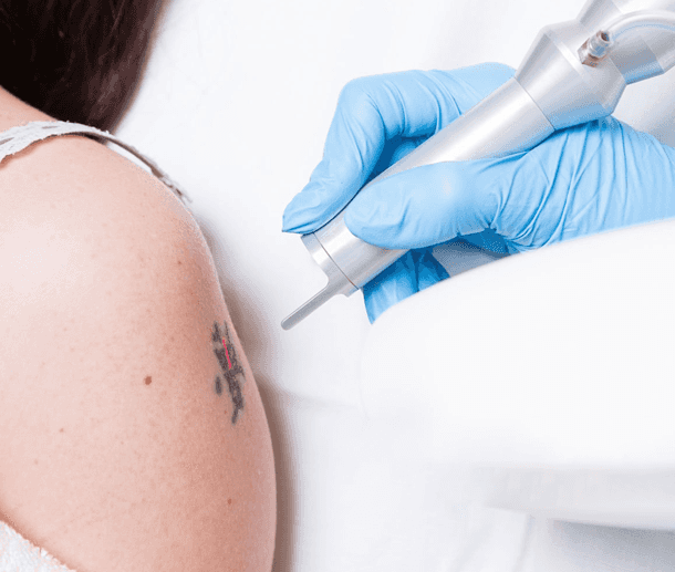 how much will laser tattoo removal cost?