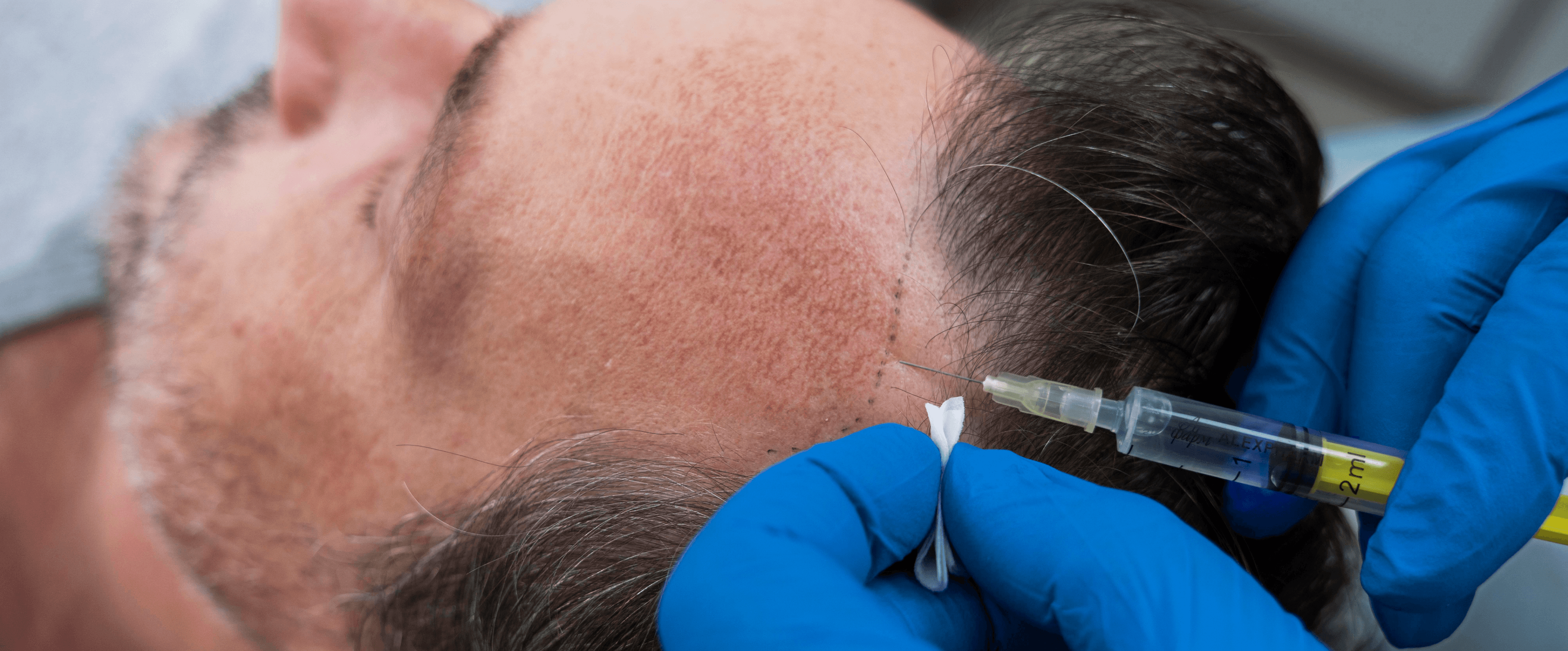 Hair Loss Treatment