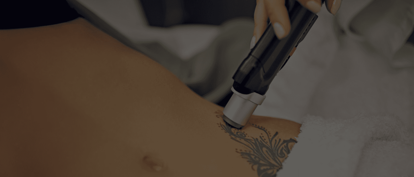 Laser Tattoo Removal