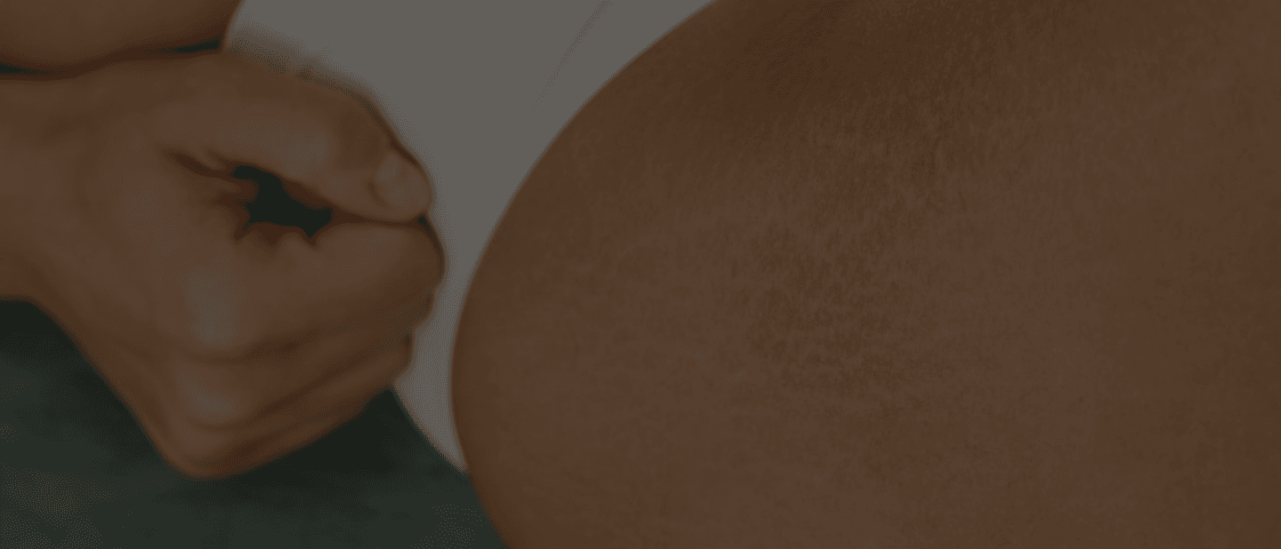 Stretch Marks Treatment
