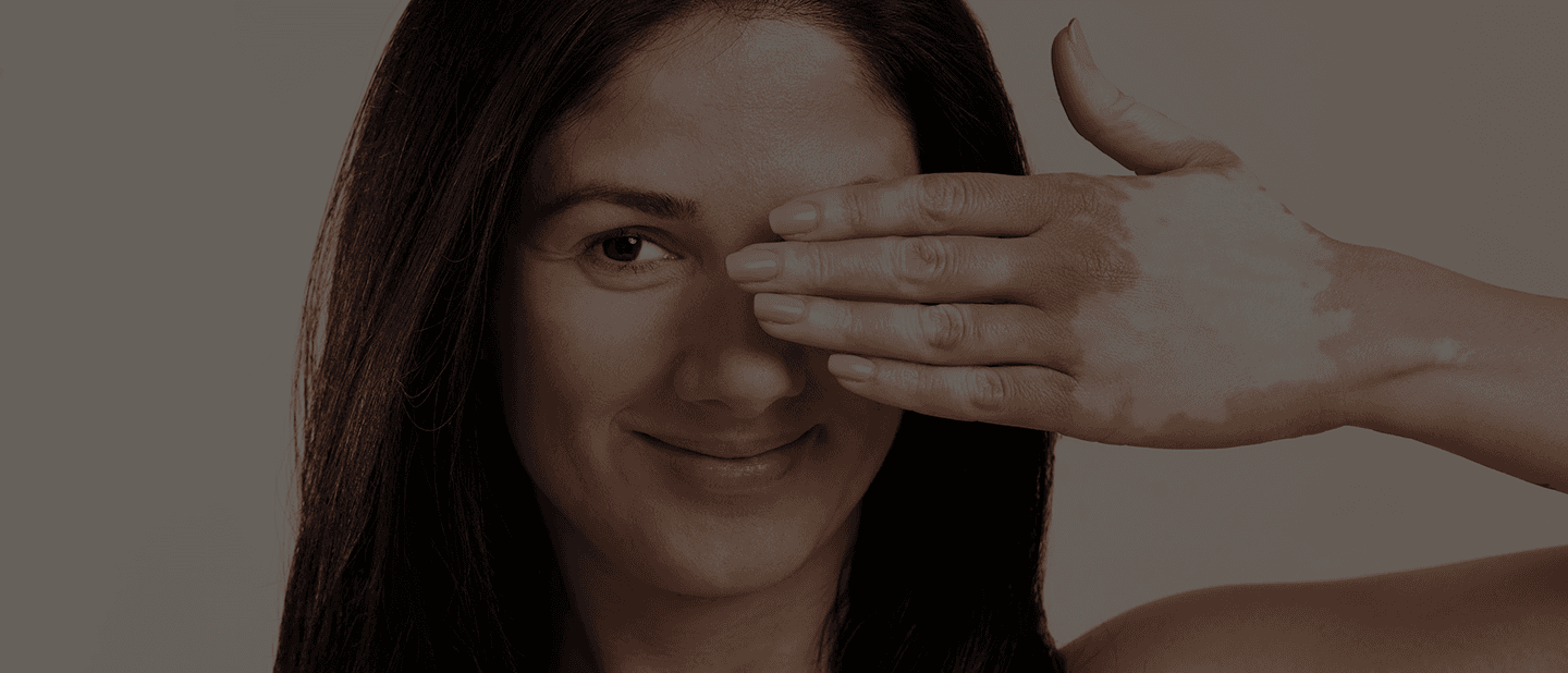 Vitiligo Treatment