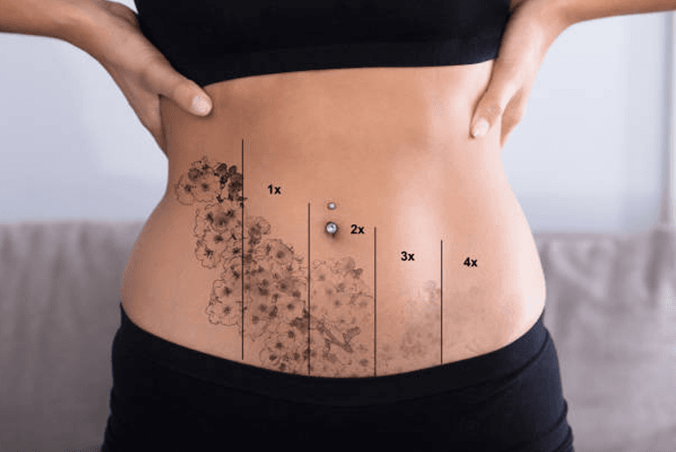 what exactly is laser tattoo removal?