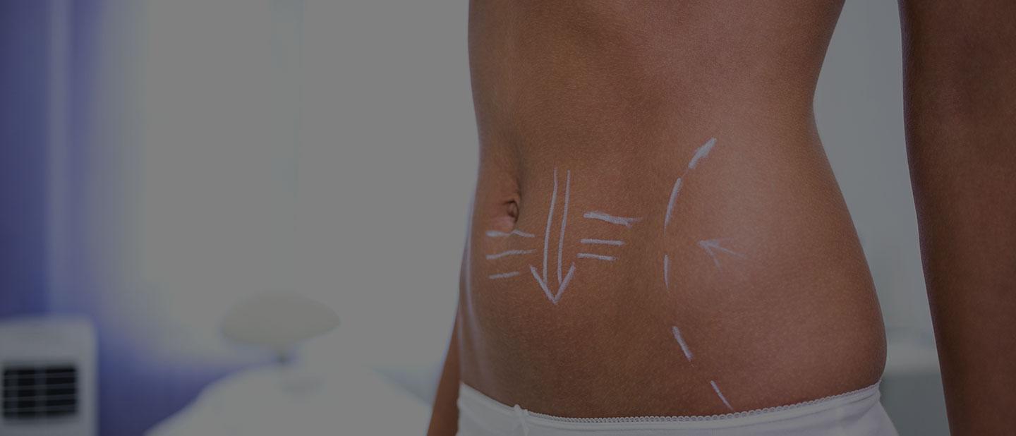 Abdominoplasty Surgery