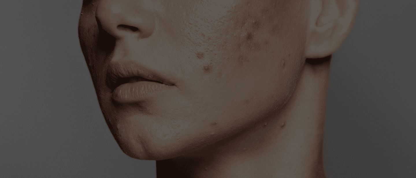 Acne Treatment