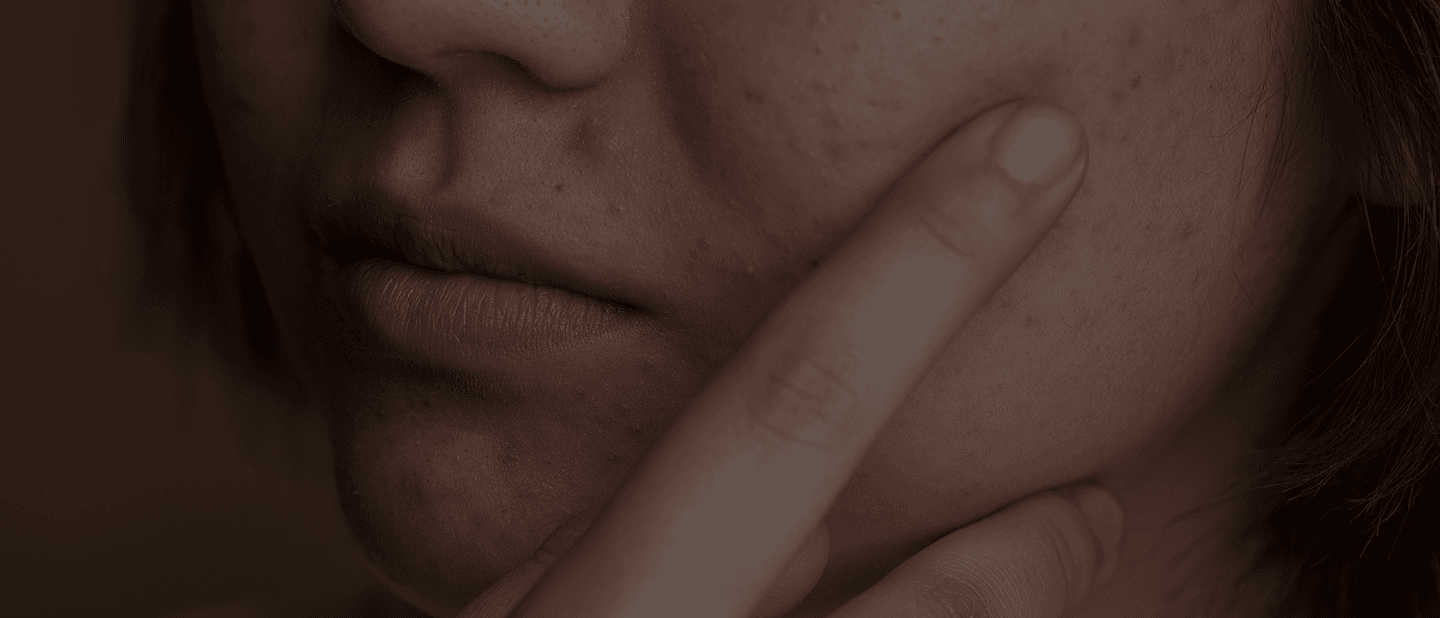 Acne Treatment in Ludhiana