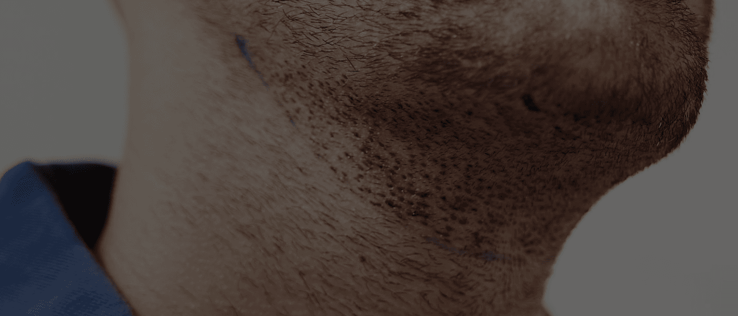 Beard Hair Transplant