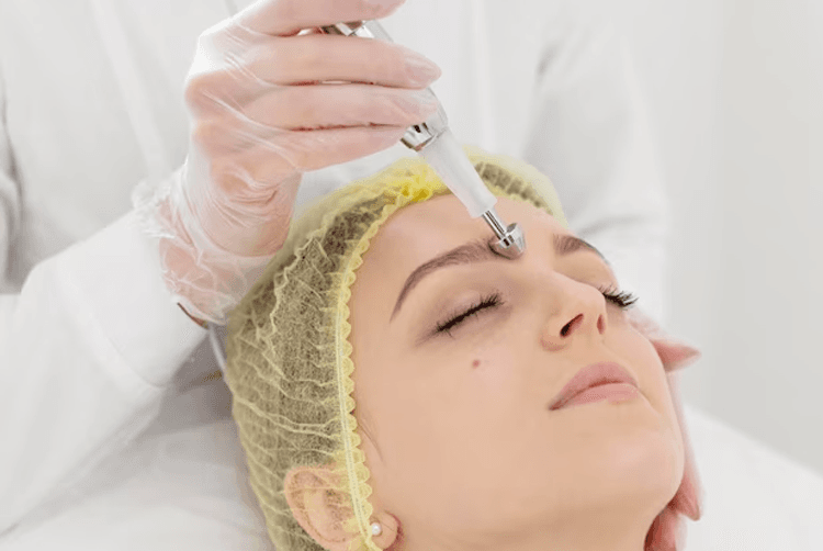 what is chemical peels?