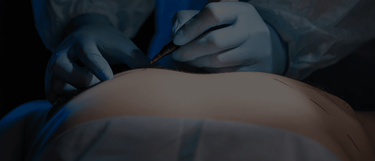 Gynecomastia Surgery