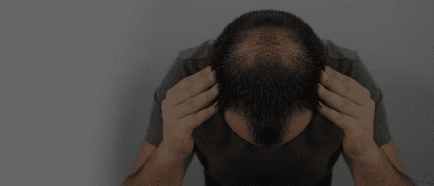 Hair Loss Treatment in Delhi
