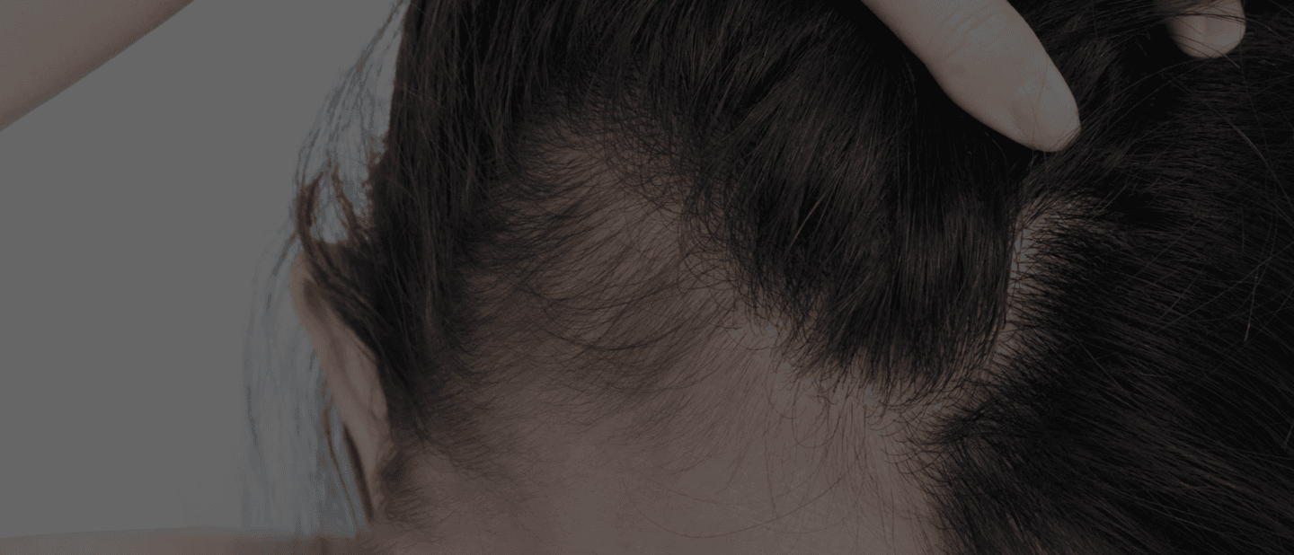 Hair Loss in Women 