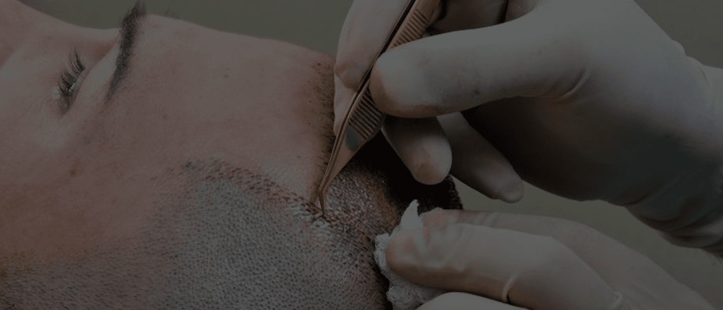 Hair Transplant Techniques