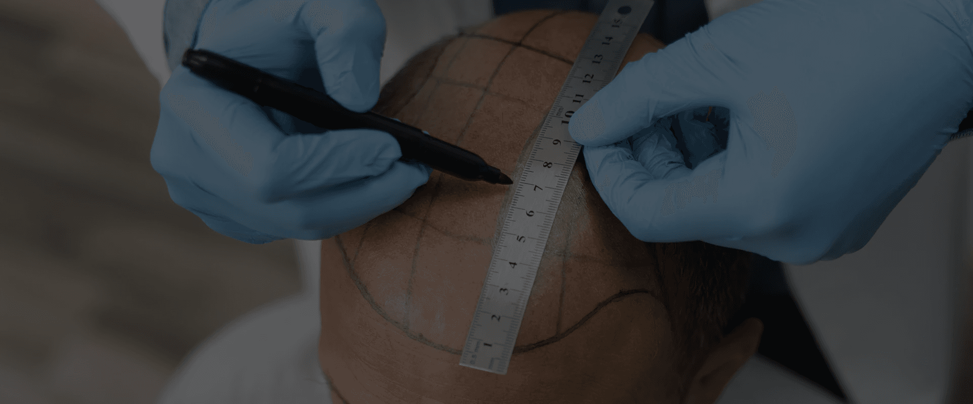 Hair Transplant