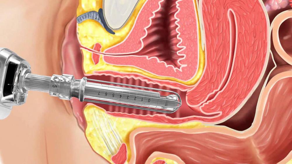 what is laser vaginal rejuvenation?