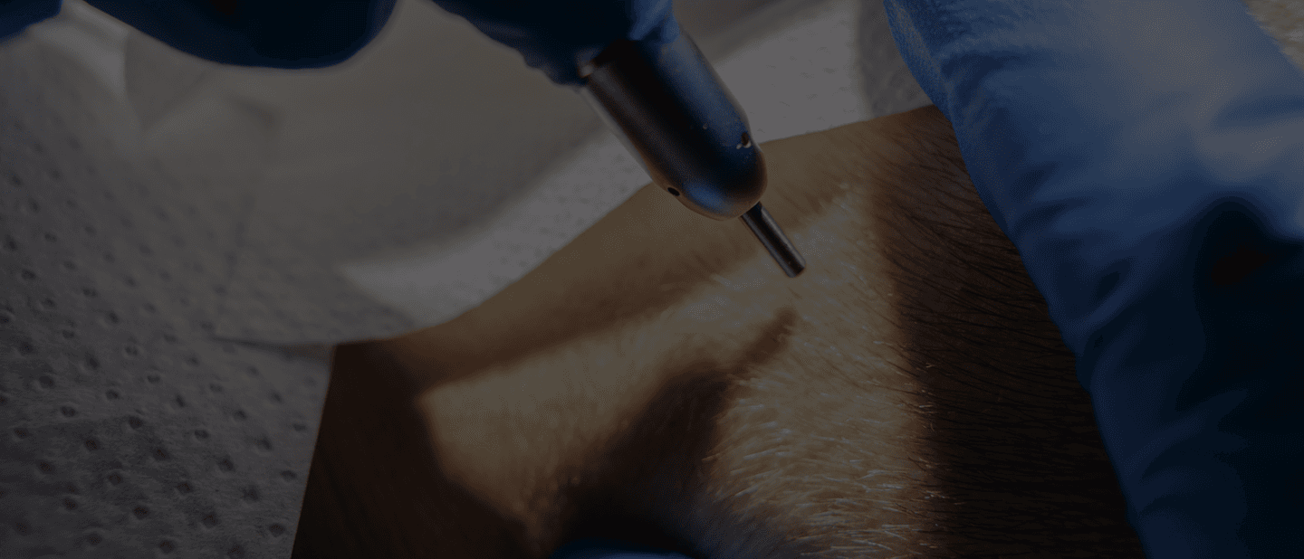 Men Hair Transplant