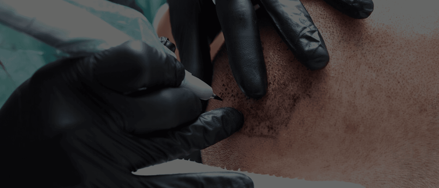 Scalp Micropigmentation 