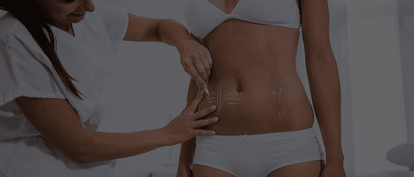 Stretch Marks Treatment in Bangalore