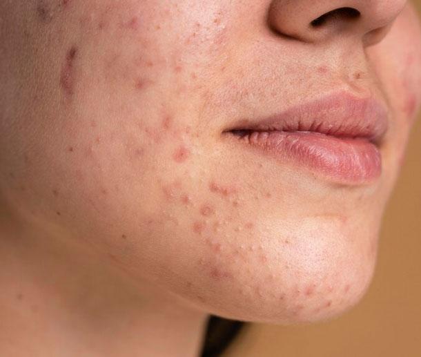what is acne treatment?