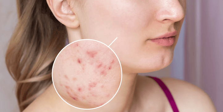 what is acne?