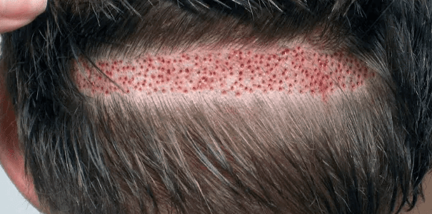 what is fut hair transplant