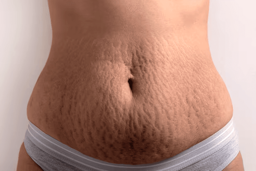 what is stretch mark?