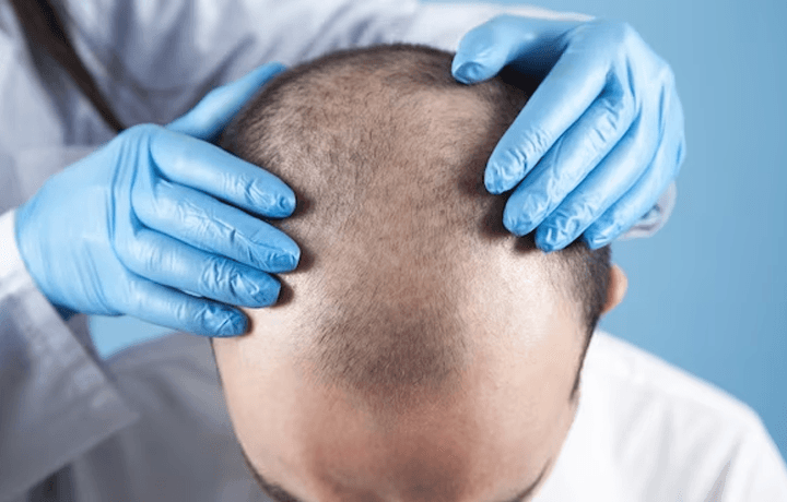 Bio-FUE<sup>TM</sup> Hair Transplant