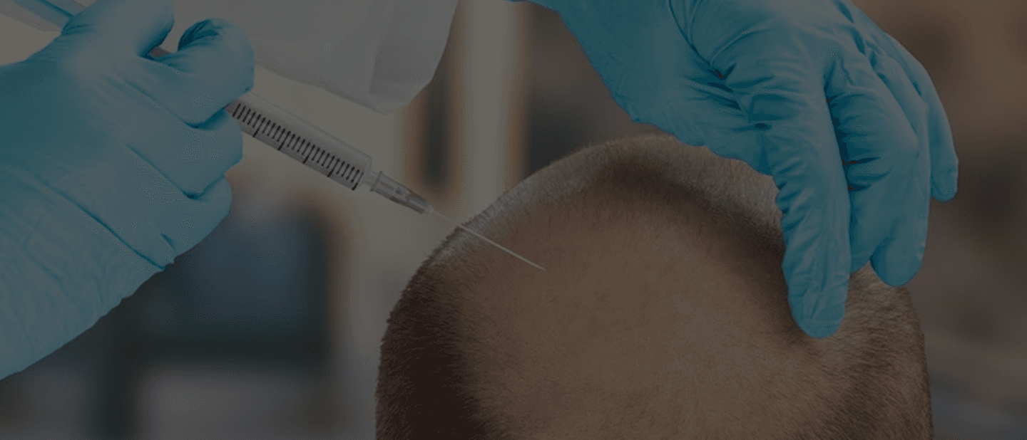 Revision Hair Transplant