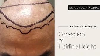 HAIRLINE RECONSTRUCTION SURGERY BY DR KAPIL DUA