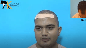 HAIR TRANSPLANT RESULT - 2098 GRAFTS BIO-FUE