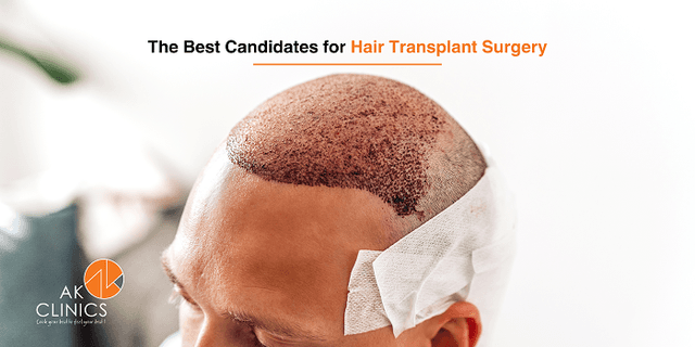 The Best Candidate for Hair Transplant Surgery