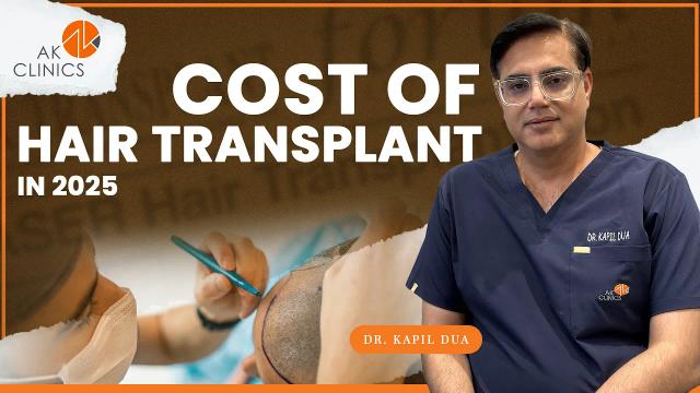 Hair Transplant Cost in 2025: What You Need to Know – Dr. Kapil Dua