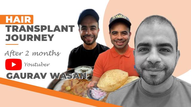 Gaurav Wasan (Swad Official) Hair Transplant | 2 Months Experience at AK Clinics, Delhi