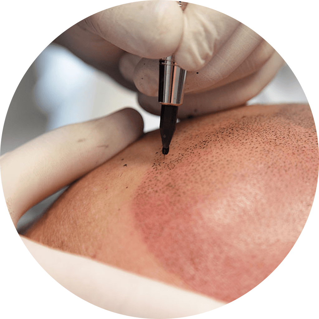 Scalp Micropigmentation (SMP)