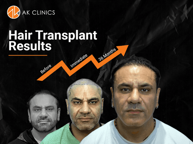 hair transplant cost in Punjab