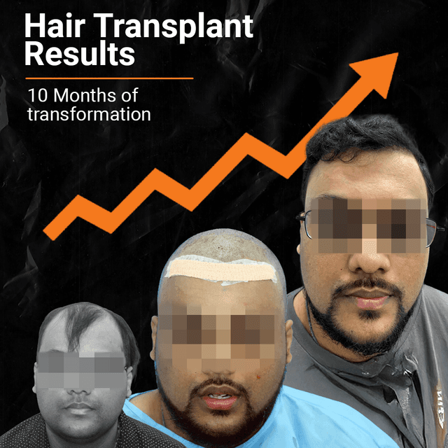 hair transplant cost chandigarh