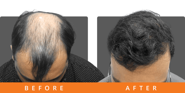 Ravi gupta hair-transplant results