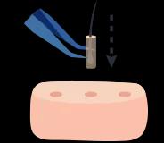 Hair Transplant in Delhi