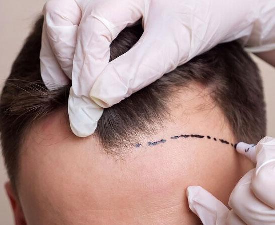 Planning-Hairline-Design