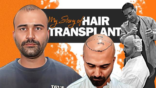 Hair transplant Patient Review at AK Clinics