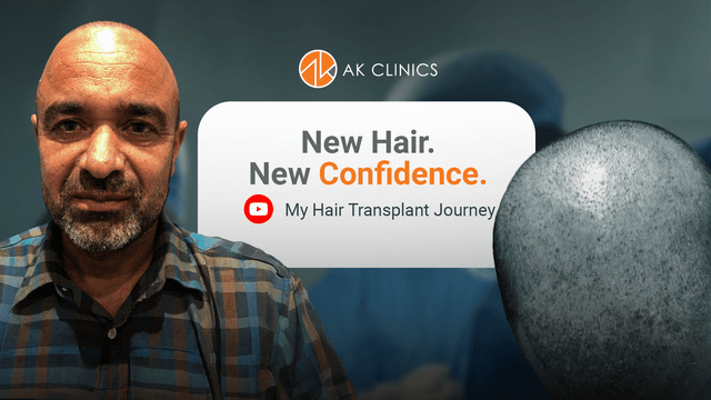 3500 Grafts Bio-FUE Transplant in Ludhiana